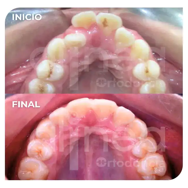 especialista en protrusion dental clase II 1 brackets dientes salidos inclinados hacia adelante 5