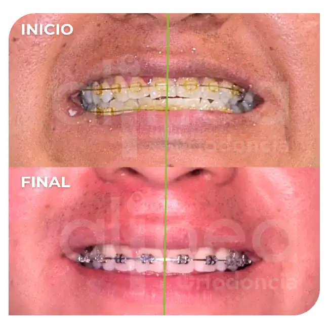 especialista en retratamiento de ortodoncia brackets por segunda vez línea media desviada miniimplante minitornillo surco lima 1