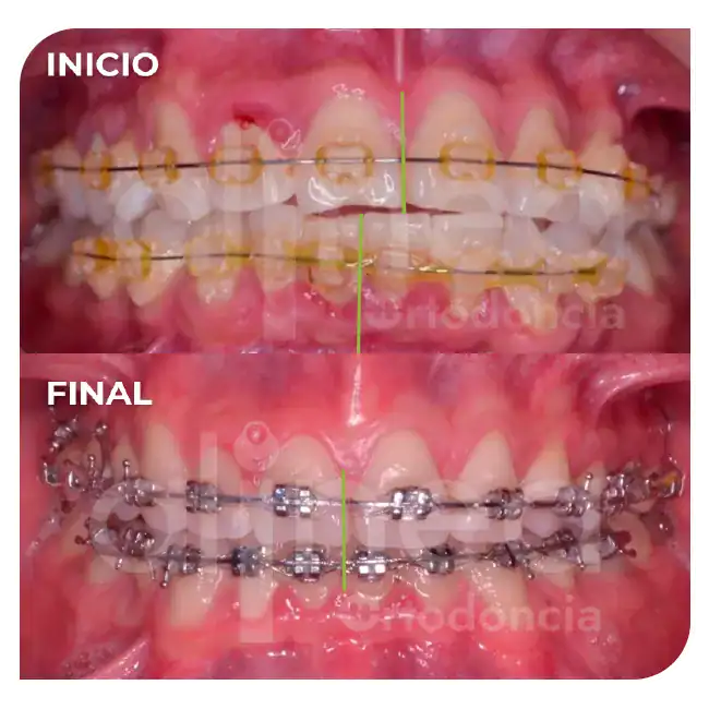 especialista en retratamiento de ortodoncia brackets por segunda vez línea media desviada miniimplante minitornillo surco lima 2