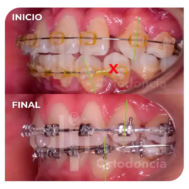 especialista en retratamiento de ortodoncia brackets por segunda vez línea media desviada miniimplante minitornillo surco lima 3