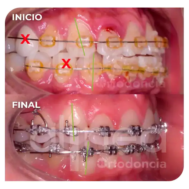 especialista en retratamiento de ortodoncia brackets por segunda vez línea media desviada miniimplante minitornillo surco lima 4