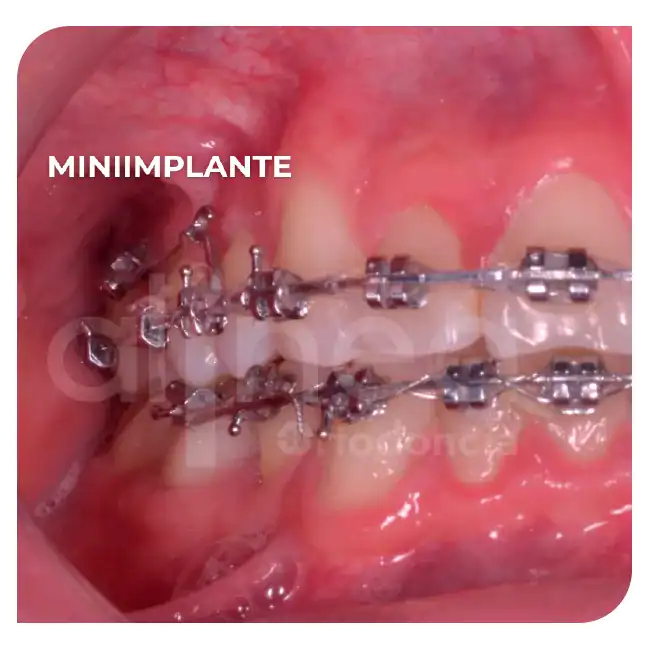 especialista en retratamiento de ortodoncia brackets por segunda vez línea media desviada miniimplante minitornillo surco lima 5