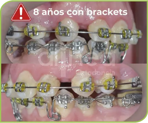 Ortodoncia para adultos Lima Peru