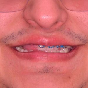 Me puedo poner brackets si me faltan 4 muelas