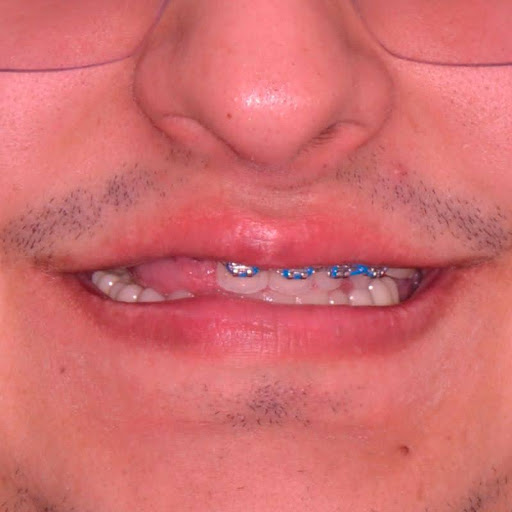 Me puedo poner brackets si me faltan 4 muelas