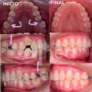 Me puedo poner brackets si me faltan dientes o muelas