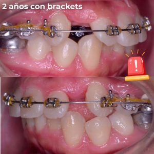 como saber si proceso de ortodoncia va mal