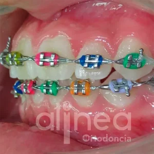 cual es el mejor color brackets lima peru surco