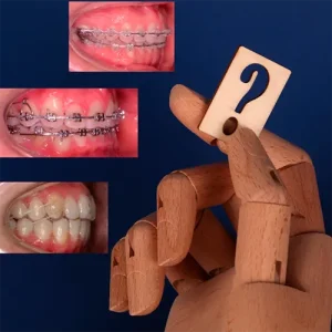 cual es la mejor ortodoncia para adultos