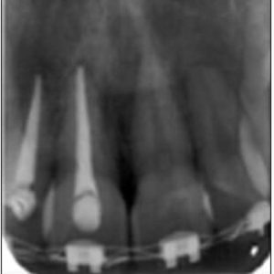 me puedo poner brackets si tengo endodoncia