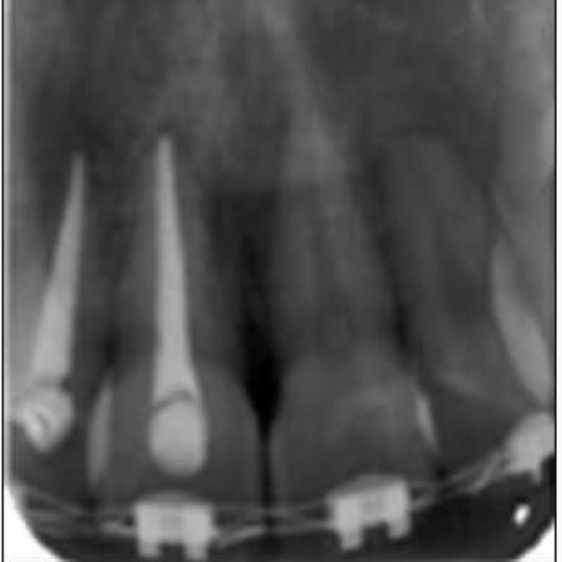 me puedo poner brackets si tengo endodoncia