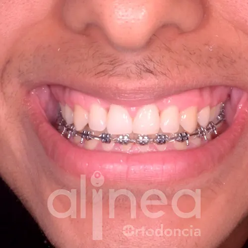 puedo ponerme brackets solo en los dientes de abajo 2