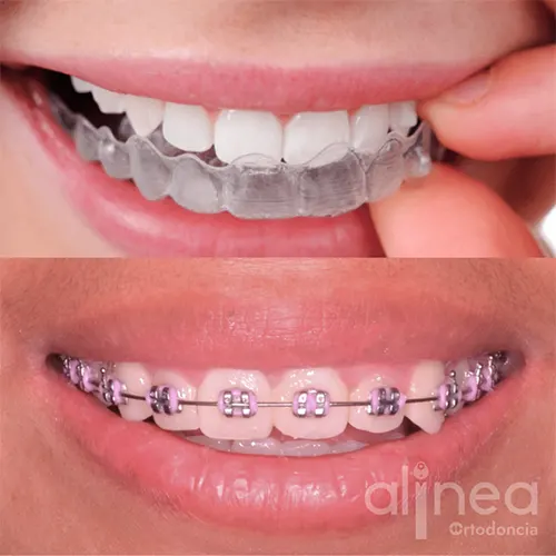 Cuál es mejor brackets o Invisalign