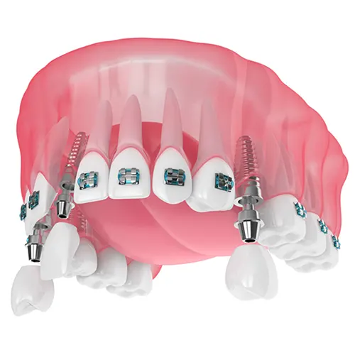 Me puedo poner brackets si tengo algún diente postizo LIMA PERU