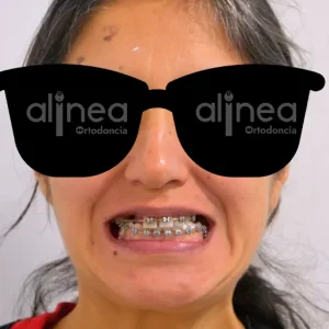 hasta que edad puedo ponerme brackets